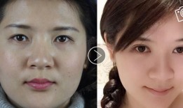 双眼皮手术后的效果，美丽蜕变与术后护理