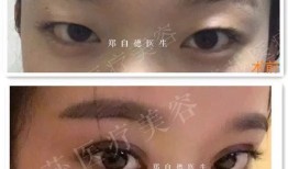 双眼皮手术体验，从紧张到自信的蜕变之旅