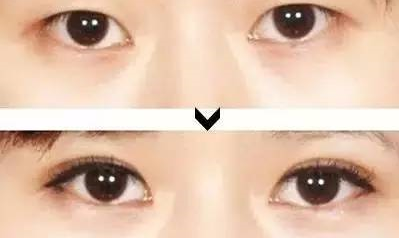 双眼皮手术的后遗症及其预防措施
