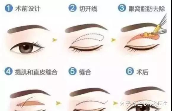 双眼皮手术后的潜在后遗症及其应对策略