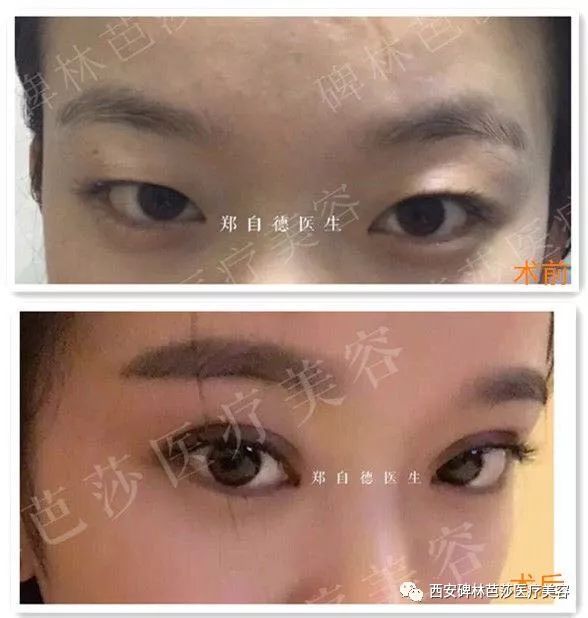 双眼皮手术后的潜在后遗症及其应对策略