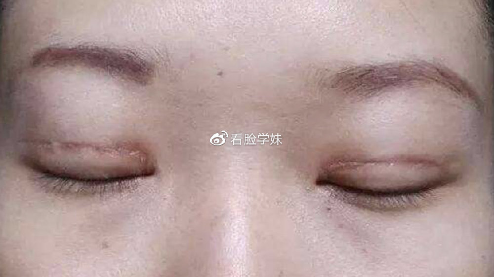 双眼皮手术后会不会留疤，全面解析术后恢复与疤痕预防