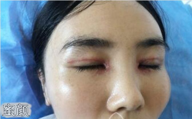 双眼皮手术后会不会留疤，全面解析术后恢复与疤痕预防
