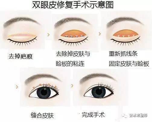 双眼皮术后的后遗症，了解风险与预防措施