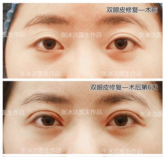 双眼皮术后的后遗症，了解风险与预防措施