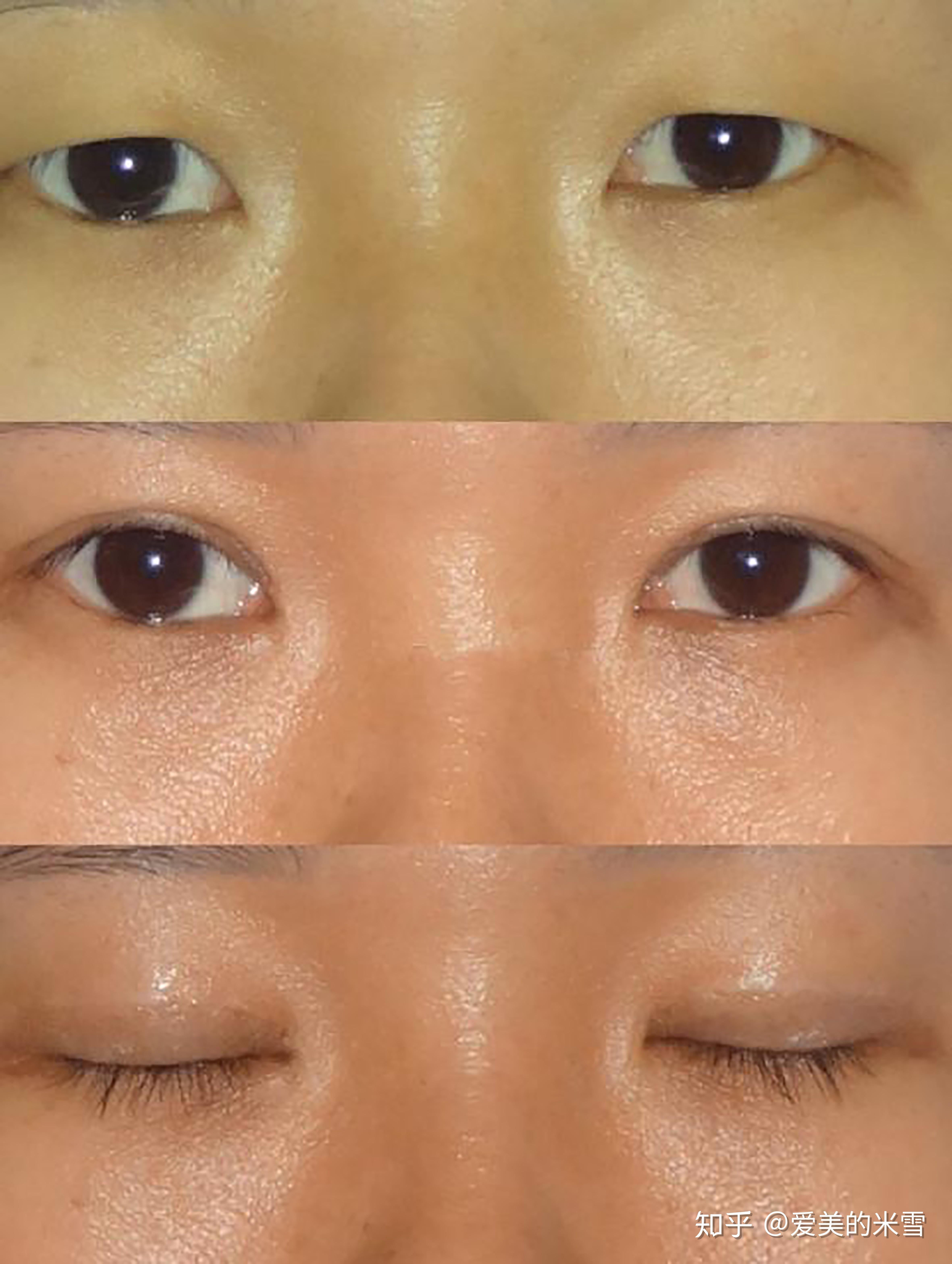 双眼皮术后的后遗症，了解风险与预防措施