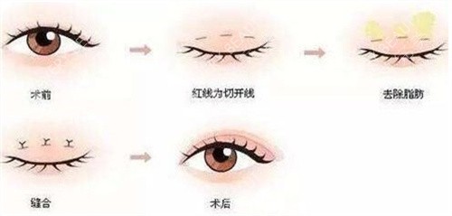 双眼皮手术后的可能后果与注意事项