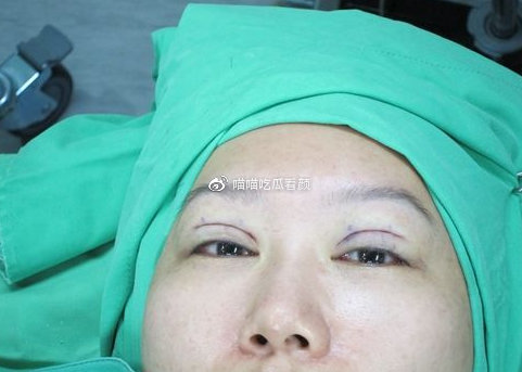 双眼皮手术后的可能后果与注意事项