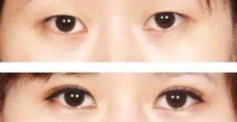 双眼皮手术后的潜在后遗症及其预防措施
