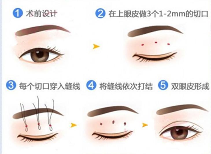 双眼皮手术后的潜在后遗症及其预防措施