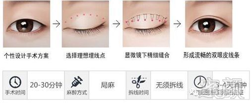 双眼皮手术，对眼睛的影响及其风险评估