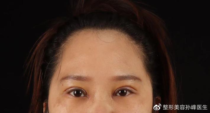 双眼皮手术后对怀孕的影响，科学解析与专业建议