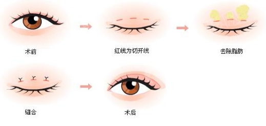 双眼皮手术后对怀孕的影响，科学解析与专业建议