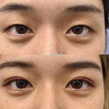 双眼皮手术与财运，迷信与现实的碰撞