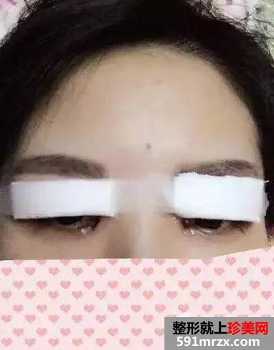 双眼皮手术恢复过程全记录，从手术到自然美