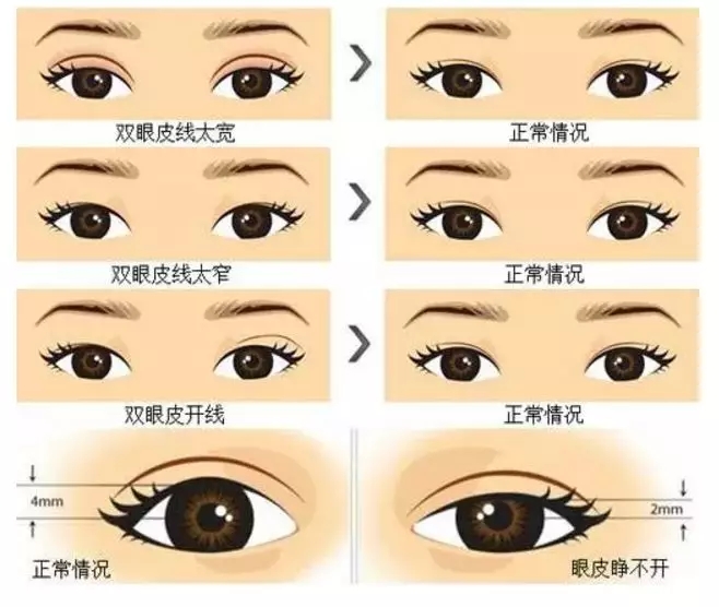 双眼皮手术的风险与可能的后遗症，全面解析