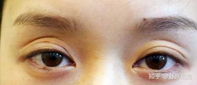 双眼皮手术后的后遗症，了解可能的风险与预防措施