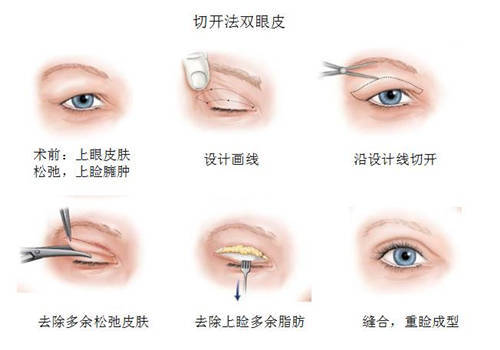 双眼皮手术后遗症，了解风险与预防措施
