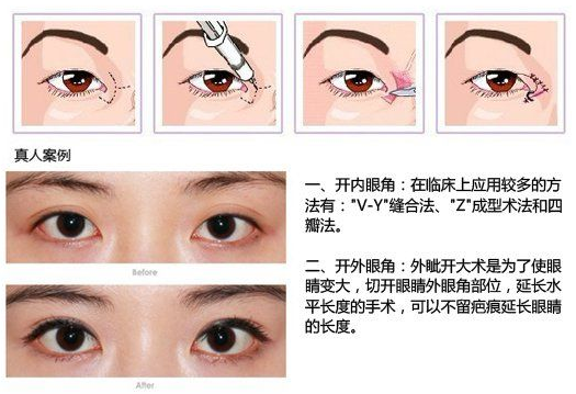 双眼皮手术的后遗症，了解风险与预防措施