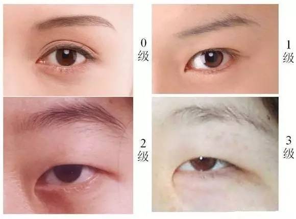 双眼皮手术后的后遗症，了解风险与预防措施