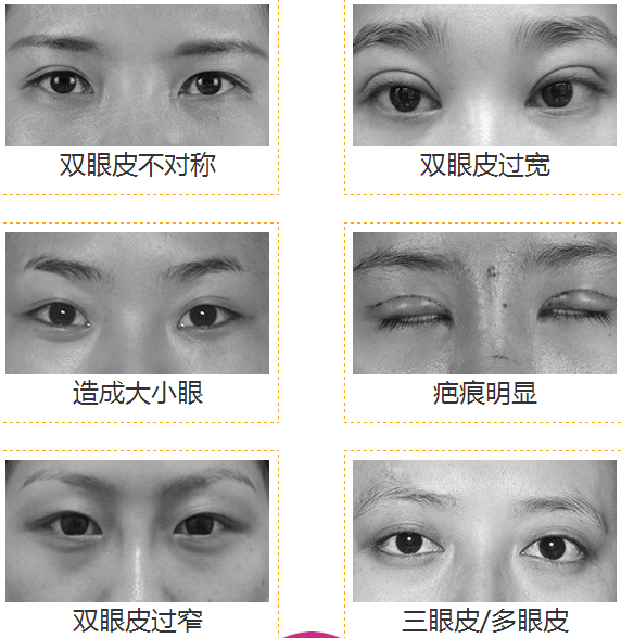 双眼皮手术后的后遗症，了解风险与预防措施