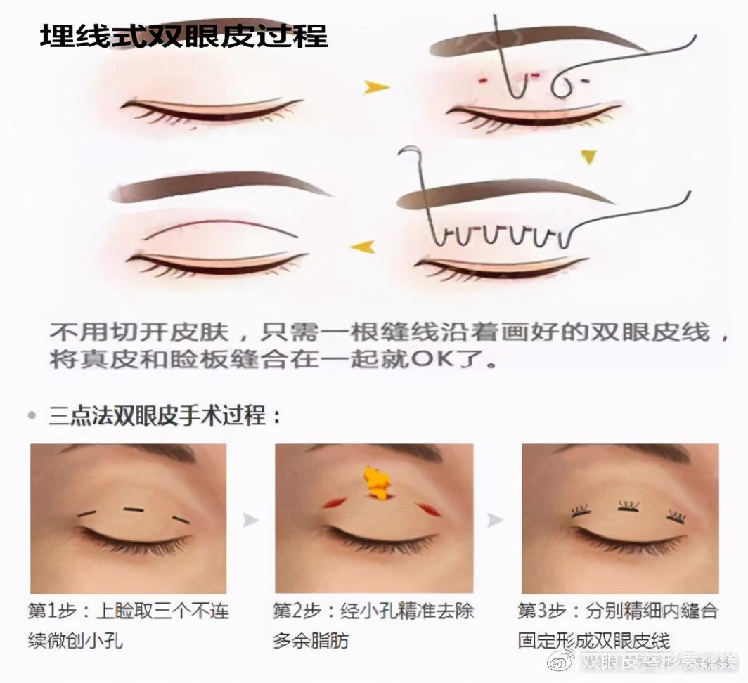 双眼皮手术的后遗症及其预防措施